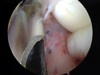 Picture1 Arthroscopic Elbow Arthrofibrosis Release